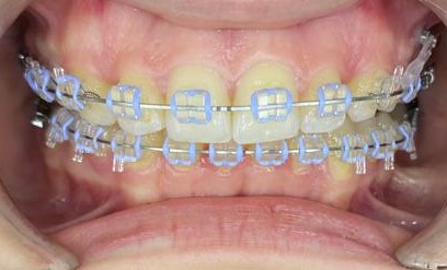 Tratament ortodontic-aparat safir